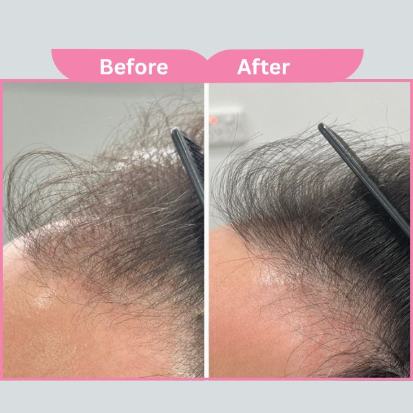 PRP Hair Treatment Results - Before & After