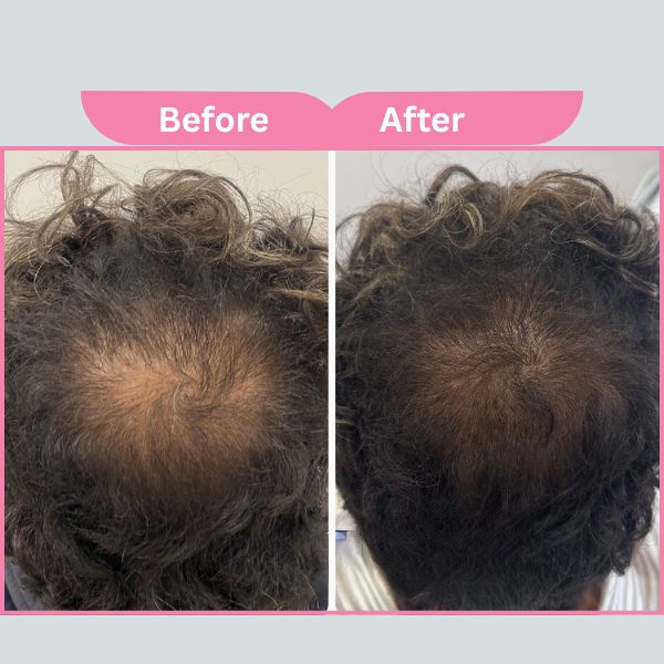 PRP Treatment Before After Results