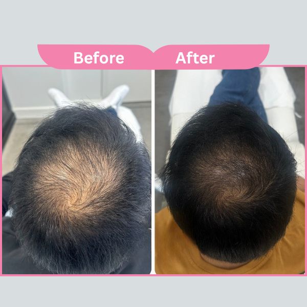 PRP Hair Treatment Mumbai Results