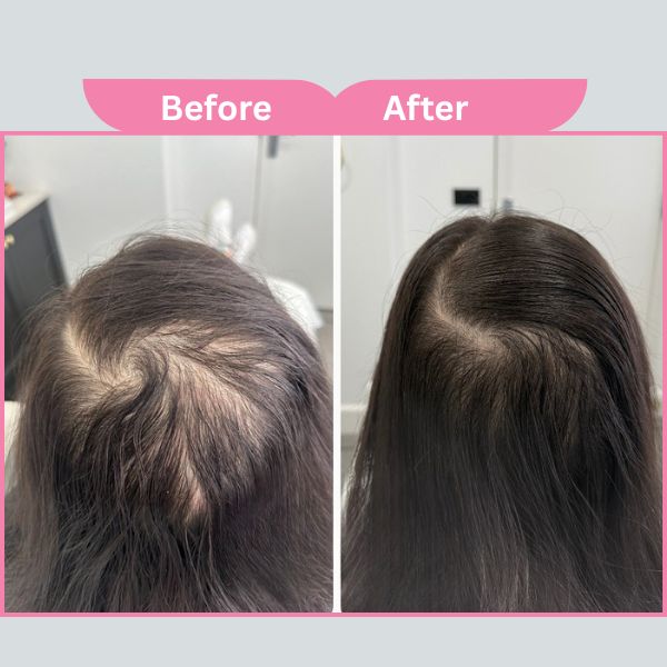 PRP Treatment Results Mumbai