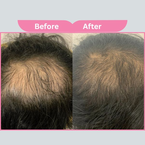 PRP Hair Treatment Before After Mumbai