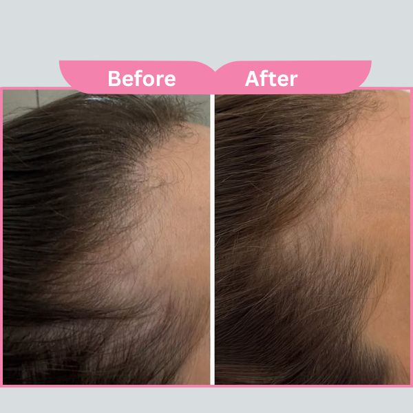 PRP Treatment Results Mumbai Clinic