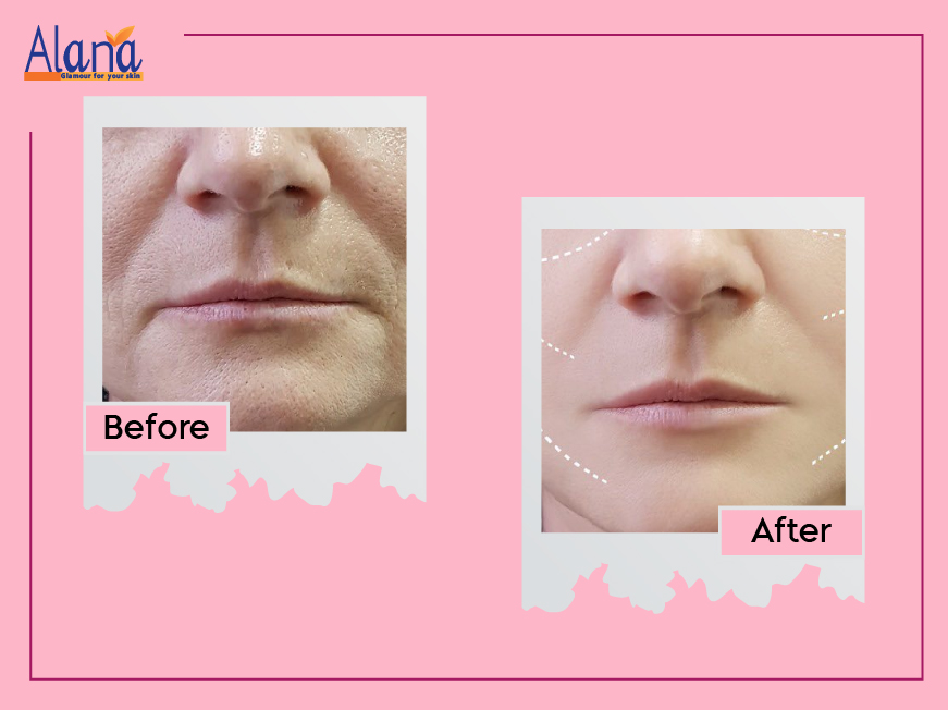 Patients before after treatment results for Skin Tightening Treatment at Alana Skin Hair & Laser Clinic in Mumbai, led by Dr. Sweta Sinha located at Ghatkopar, Tilak Nagar Chembur.