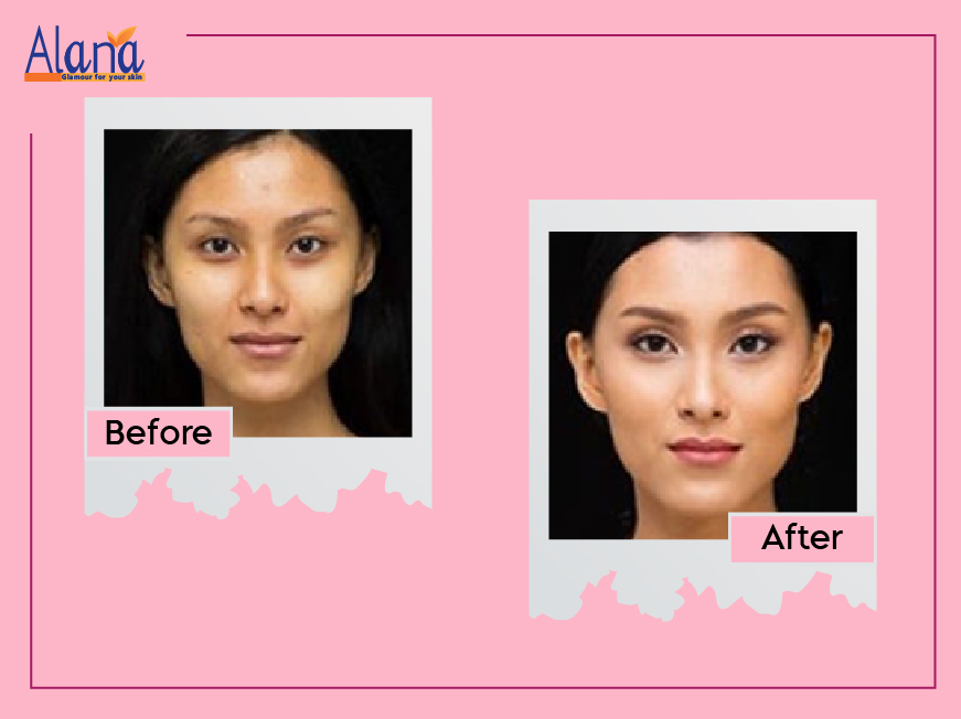 Patients before after treatment results for Skin Whitening Treatment at Alana Skin Hair & Laser Clinic in Mumbai, led by Dr. Sweta Sinha located at Ghatkopar, Tilak Nagar Chembur.