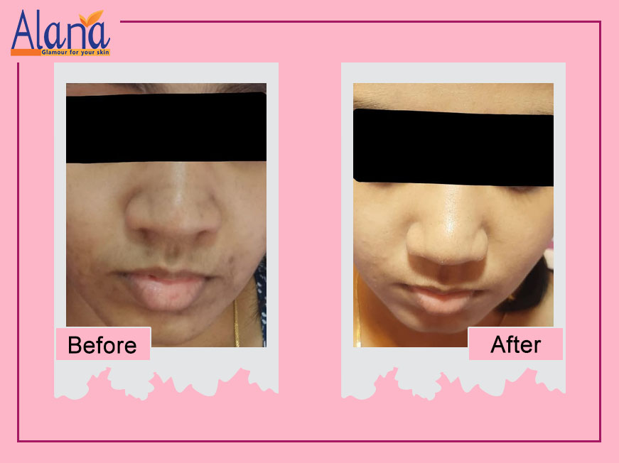 Patients before after treatment results for skin rejuvenation and resurfacing Treatment at Alana Skin Hair & Laser Clinic in Mumbai, led by Dr. Sweta Sinha located at Ghatkopar, Tilak Nagar Chembur.