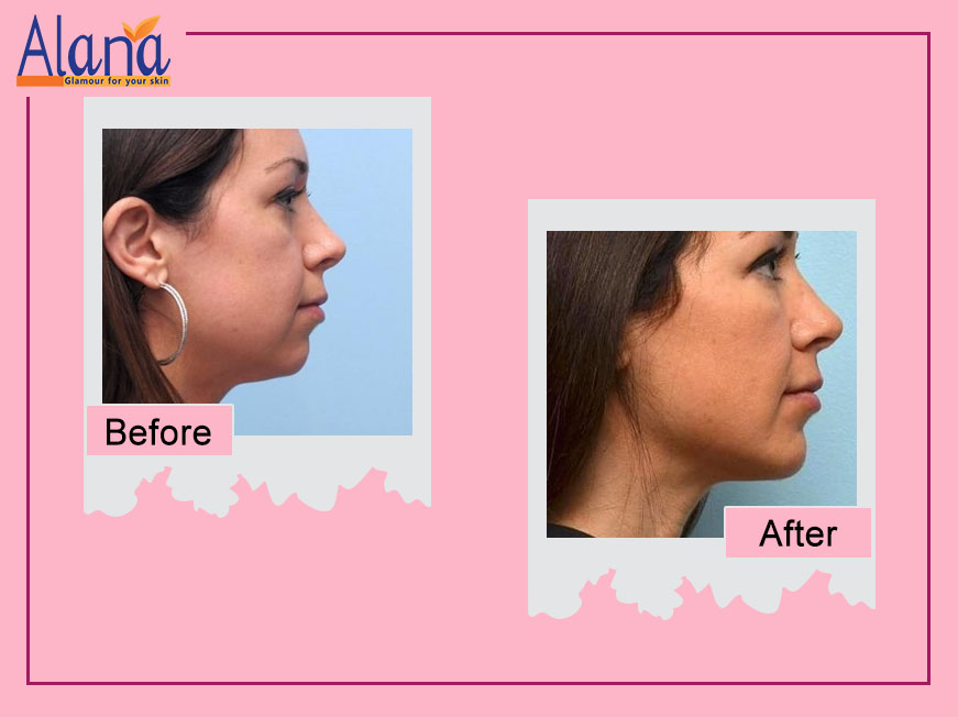 Patients before after treatment results for SkinTreatment at Alana Skin Hair & Laser Clinic in Mumbai, led by Dr. Sweta Sinha located at Ghatkopar, Tilak Nagar Chembur.