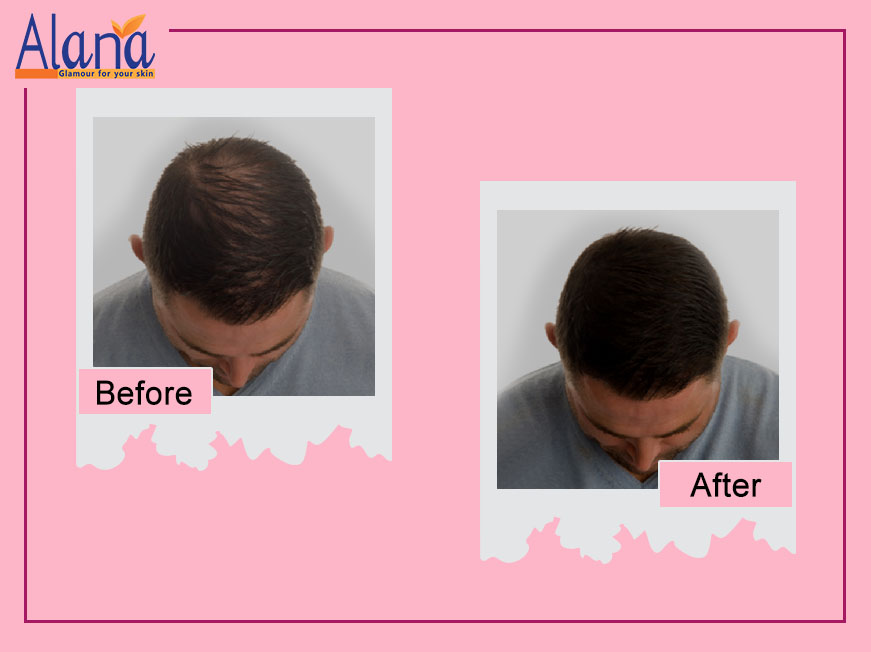 Patients before after treatment results for Hair ReGrowth Treatment at Alana Skin Hair & Laser Clinic in Mumbai, led by Dr. Sweta Sinha located at Ghatkopar, Tilak Nagar Chembur.