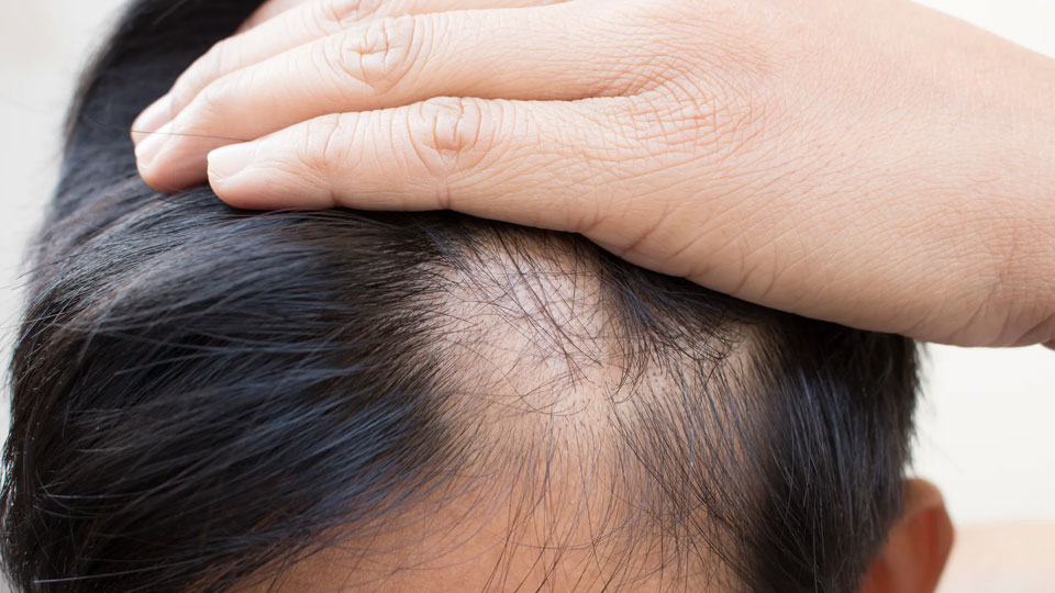 Discover the best Alopecia/Hair Loss Treatment in Mumbai at Alana Skin Hair & Laser Clinic by Dr. Sweta Sinha in Ghatkopar, Tilak Nagar, Chembur.