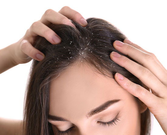 At Alana Skin Hair & Laser Clinic we offer the best dandruff/seborrheic dermatitis treatment in Mumbai at Ghatkopar, Tilak Nagar, Chembur by Dr. Sweta Sinha.