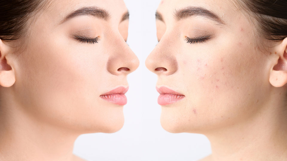 Experience flawless skin with best Acne Peel Treatment at Alana Skin Hair & Laser Clinic in Mumbai, led by Dr. Sweta Sinha in Ghatkopar, Tilak Nagar & Chembur.