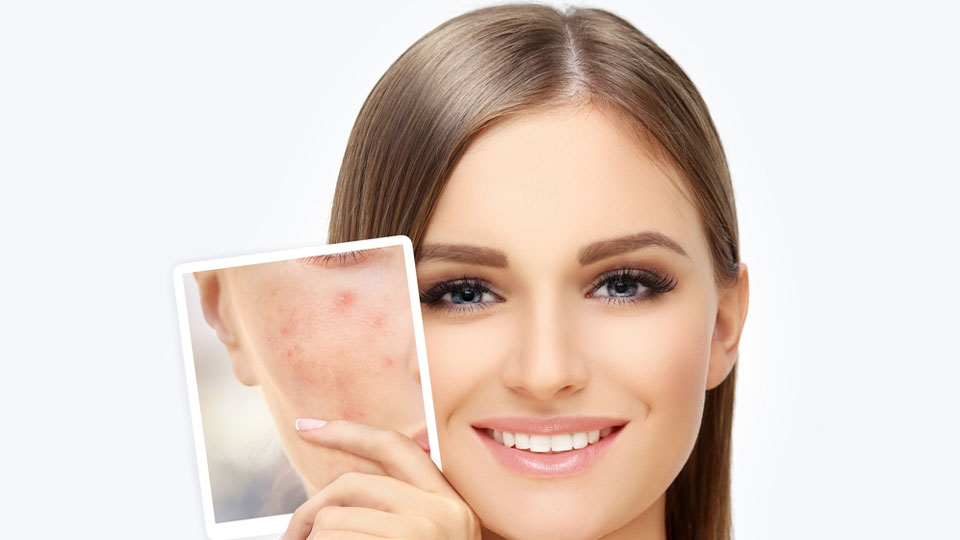 Experience the finest Acne Treatment in Mumbai at Alana Skin & Laser Clinic. Led by expert dermatologists, Dr. Sweta Sinha and restore clear, radiant skin.