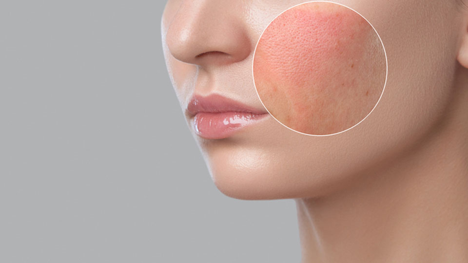 Explore skin pigmentation, its types, causes, and conditions like hyperpigmentation and hypopigmentation at Alana Clinic, Ghatkopar, Mumbai, by Dr. Sweta Sinha.